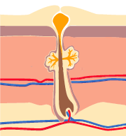 L’acné