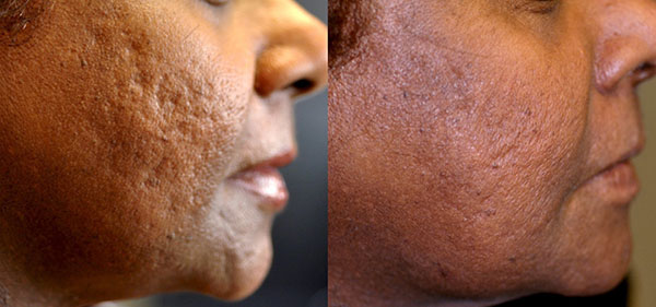 Cicatrice d'acné