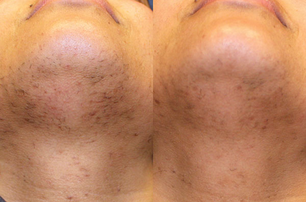 Epilation laser du visage