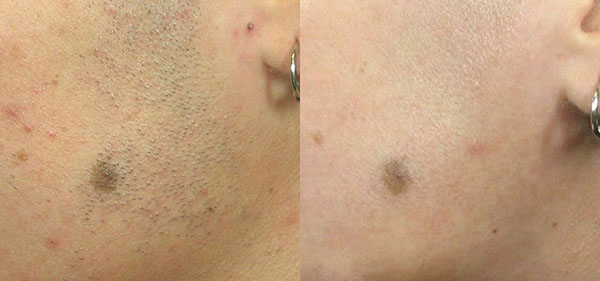 Epilation laser du visage