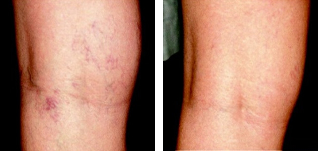 Varicosités jambes